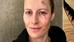Skicross: Fanny Smith donne des nouvelles rassurantes après sa lourde chute